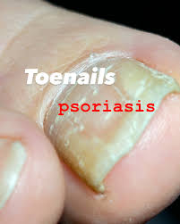 Image result for Pitting nails feet