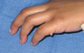 Image result for Supernumerary Digit