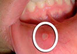 Cancerul De Colon Factori De Risc Simptome Tratament Cancer Intestinal Cauze
