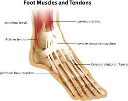 The two tendons involved are the peroneus longus and peroneus brevis. Torn Ligament Or Tendon In The Foot