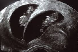So entwickelt sich dein baby. Meine Zwillinge 10 Ssw Forum Schwangerschaft Urbia De