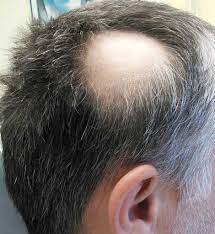That being said, a dog losing more of its hair coat than from. Scalp Micropigmentation For Bald Spots Scalp Micro Portugal