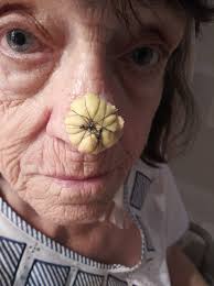 I remember my mom visiting a woman that had nose cancer. She didn't have a  nose. I can't remember her name she lived in the area..