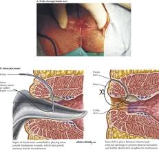 Image result for Perianal Abscess