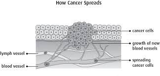 Cancer cells can break away and spread to other areas of the body, causing secondary cancer. How Cancer Starts Grows And Spreads Canadian Cancer Society