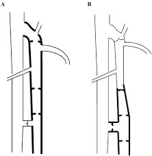 Knitting cycle of compound needle. Morphology And Progression In Primary Varicose Vein Disorder Due To 677c T And 1298a C Variants Of Mthfr Ebiomedicine