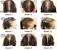 Female Pattern Baldness