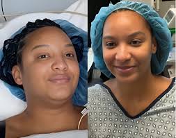 Chantel's Birthmark Removal Decision