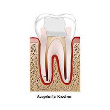 Wenn die nasennebenhöhlen entzündet sind, verschreiben ärzte oft antibiotika. Wurzelspitzenresektion Behandlung Dauer Risiken