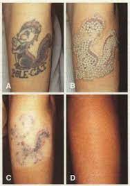Results can start to be seen around the 3rd session. 65 Tattoo Removal Before And After Ideas Laser Tattoo Removal Tattoo Removal Laser Tattoo