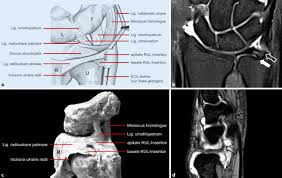 The triangular fibrocartilage complex (tfcc) is formed by the triangular fibrocartilage discus (tfc), the radioulnar ligaments (ruls) and the ulnocarpal ligaments (ucls). Der Ulnokarpale Komplex Springerlink