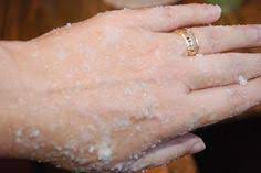 Home Remedy For Dry Chapped Hands Chapped Hands Skin Remedies Dry Skin Remedies