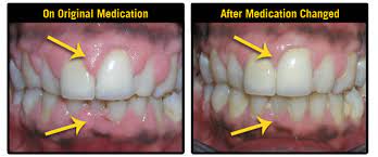 How High Blood Pressure Medication Could Cause Swollen Gums