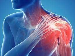 Trombose kan plotsklaps je leven veranderen. Pode Ter Trombose No Braco Dr Marcelo Bellini Dalio Medico Cirurgia Vascular E Endovascular