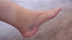 Maybe you would like to learn more about one of these? Ankle Injuries A Simple Guide To Fixing Them 5 A Side Com