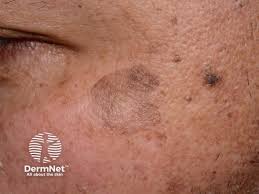 Image result for Solar Lentigo