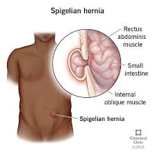 Image result for stomach hernia symptoms