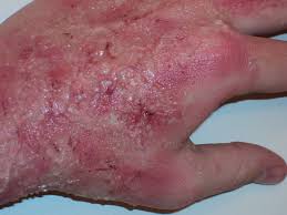 If the chemical is dry, brush it off the skin rinse continuously with clean water rinse the affected area continuously with clean water as soon as possible try to make sure the water can run off the affected area without pooling on the skin Air Conditioning Chemical Burns Death And Gases