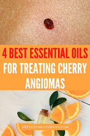 They are generally asymptomatic but may bleed if traumatized. Essential Oils For Cherry Angiomas Which Should You Use