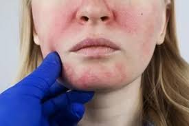 Rosacea