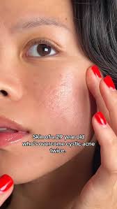 I used to feel like I was constantly losing some invisible race. I used to  compare myself to others who had perfect skin, and then I took it up  another notch and compared myself to those who did have ...