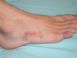 Image result for Skin Infection