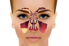 Hvis man er tett i nesen over lengre tid, er det sannsynligvis ikke forkjølelse som er årsaken. Akutt Bihulebetennelse Drop In Legene