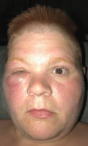 Best thing for a wasp sting