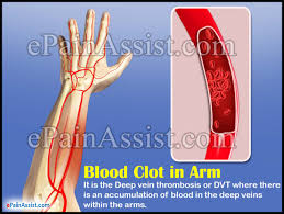 Clots most often happen in one of your legs, but. Blood Clot In Arm Symptoms Treatment Home Remedies Exercises