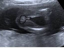 Sie sagte das ihre gyn ihr gesagt hätte, das wenn sie heute das geschlecht des baby ihr verraten. Erkennt Ihr An Dem Bild Das Geschlecht Schwanger Wer Noch