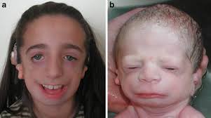 It is commonly known as treacher collins syndrome (tcs). Treacher Collins Syndrome Clinical Implications For The Paediatrician A New Mutation In A Severely Affected Newborn And Comparison With Three Further Patients With The Same Mutation And Review Of The Literature Springerlink