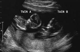 If your nausea and vomiting is super severe, definitely bring it up to your ob. What To Expect When You Re 13 Weeks Pregnant