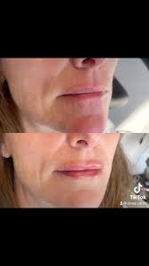 💋💋 , #restylane #lipfiller