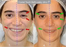 Hybrid Bell's palsy recovery program • Crystal Touch Bell's Palsy Clinic