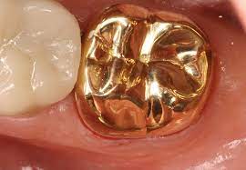 Toothpaste that gives you a healthy smile, with specialized solutions tailored to you. Why Do I Need A Crown Smilealive Dentistry