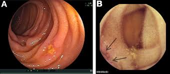 Image result for Small Intestinal Bleeding