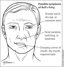 Or it might be a reaction that occurs after a viral infection. Bell S Palsy American Family Physician
