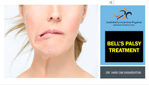 Bell's palsy usually goes away by itself without treatment. Physical Therapy For Bell S Palsy By Dr Hari Om Vashishtha