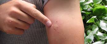 Image result for mosquito bite