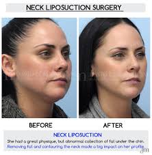 And if you want a natural hair color, a natural chestnut brown hair one of the most preferred haircuts of mature women is shaggy short haircuts. Excellent Surgical Neck Liposuction Results By Dr David Mabrie Liposuction Chin Chinfat Turkeyneck Surg Neck Liposuction Plastic Surgery Liposuction