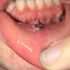 My Lip Piercing Has This Big Annoying Bump My Bad Was Too Short So I Got To Changed It S Probably About A Month Old I Now Have The Longer Bar In