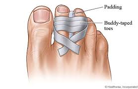 Survive Tips On Sprained And Broken Toes Broken Toe Middle Toe Athletes Foot Remedies