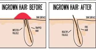 How to permanently remove pubic hair from home. Ingrown Pubic Hairs Definition Prevention Treatment Micro Bikini Store