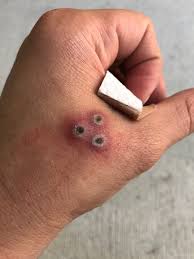 Are you looking for 3 dots tattoo, if so then you have come to the right site. This 3 Dot Tattoo Is In The Processing Of Removal Via Glycolic Acid Post 2 Weeks Does This Tattoo Look Infected Photo