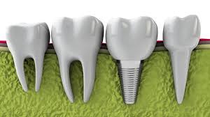 Will Dental Implants Help In Gum Disease And Bone Loss