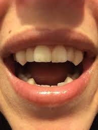 Some are fixed, while others are removable for mealtimes and sleeping. Pin On Fangs