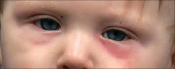 Rotung Unter Den Augen Eines Kindes Ursachen Und Behandlung