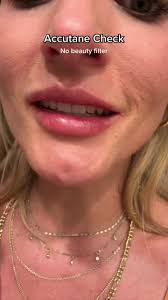 Dealing with Dry Skin