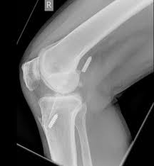 Anterior cruciate ligament (acl) tears are the most common knee ligament injury encountered in radiology and orthopedic practice. Migration Of Acl Graft Fixation Screws Radiology Case Radiopaedia Org