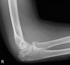 Resisted wrist extension with elbow fully extended. Intra Articular Displacement Of An Avulsed Medial Internal Epicondyle Ossification Centre In The Paediatric Elbow A Radiographic Finding Not To Be Missed Bmj Case Reports